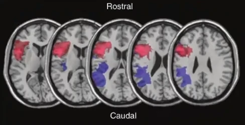 Cortes de resonancia magnética cerebral mostrando en rojo y azul las zonas rostral y caudal asociadas a distintos tipos de apraxia