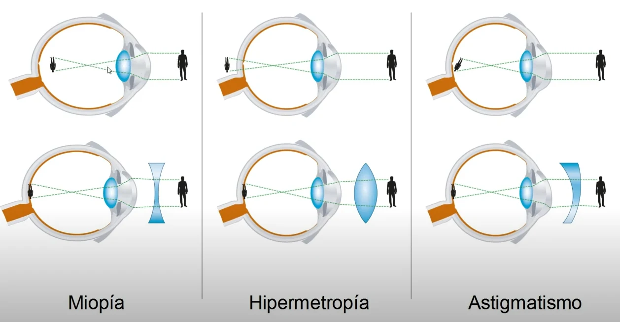 Comparación de miopía, hipermetropía y astigmatismo, con el lente correctivo usado en cada caso